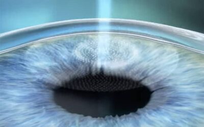 Les critères pour être un bon candidat à la chirurgie réfractive par laser selon la Clinique Néovision