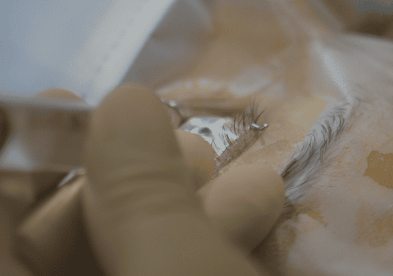 La chirurgie réfractive laser lyon