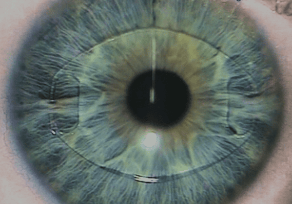 La chirurgie réfractive implants phaques intra-oculaires